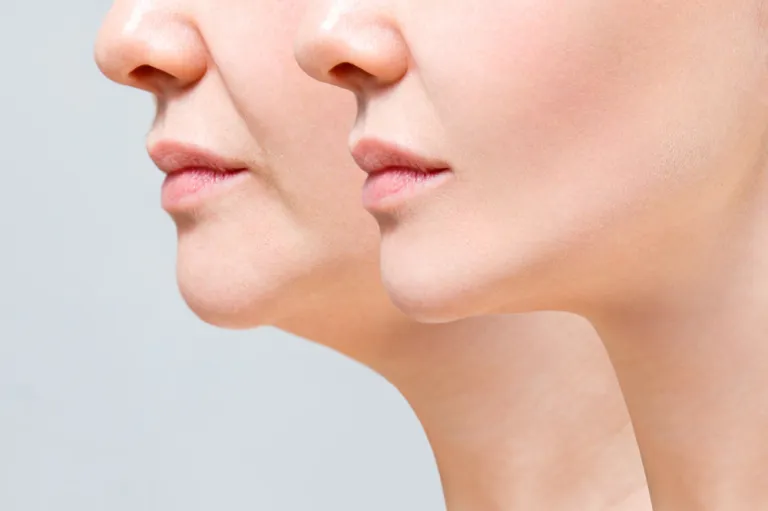Comparação de perfil do contorno facial de uma paciente